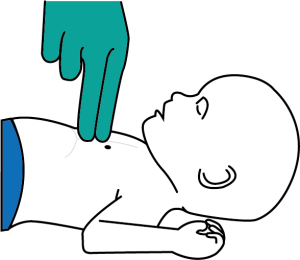 Give 30 chest compressions to relieve infant choking