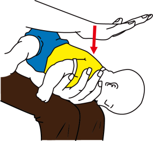 Give 5 back blows to relieve infant choking